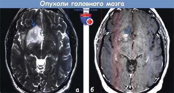 МРТ опухоли головного мозга