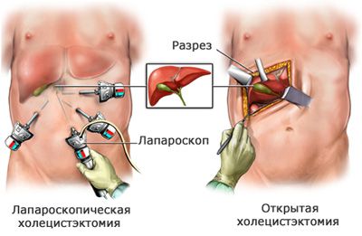 Открытая и лапароскопическая холецистэктомия