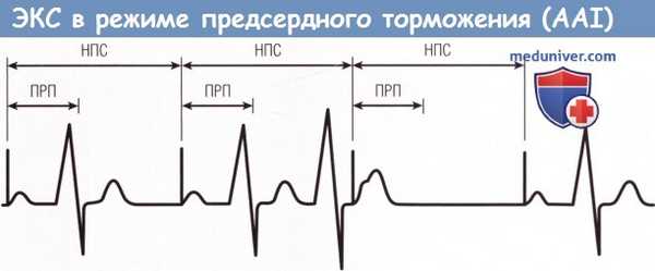 Электрокардиостимуляция в режиме AAI - предсердного торможени