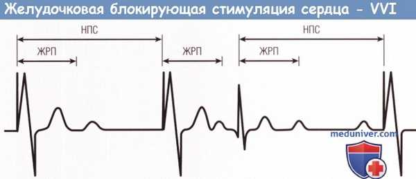 Желудочковая блокирующая стимуляция сердца - VVI