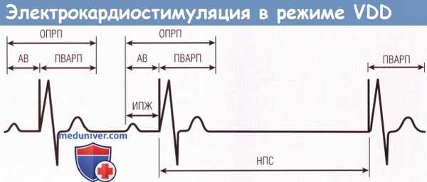 Электрокардиостимуляция (ЭКС) в режиме VDD