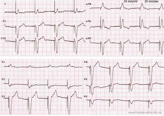 single chamber pacing unipolar