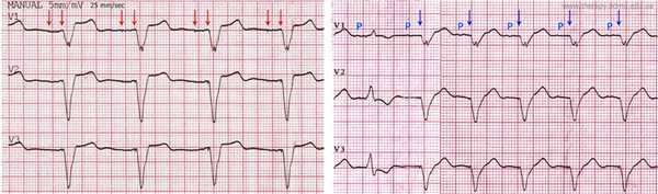 2 chamber pacing expl