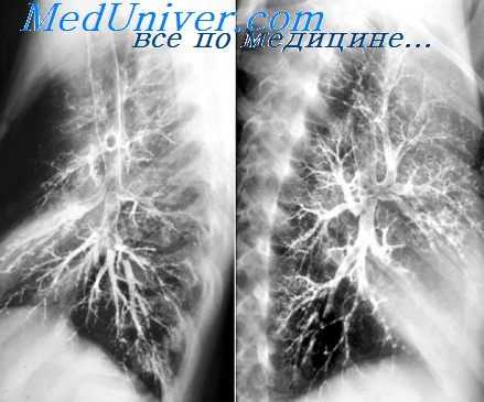 двусторонняя бронхография