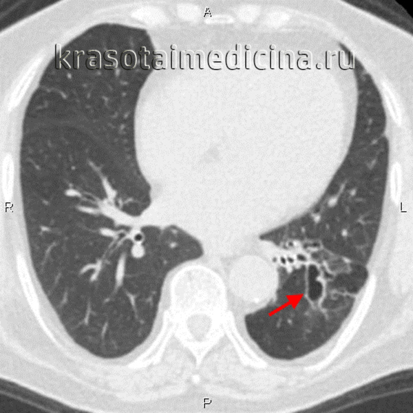 КТ органов грудной клетки. Цилиндрические бронхоэктазы в нижней доле левого легкого