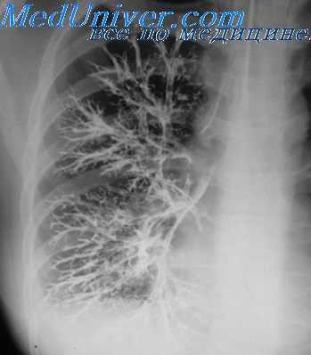 выбор метода бронхографии