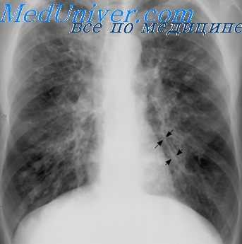 бронхография у детей