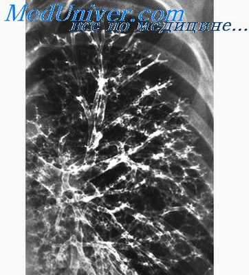 бронхоспирометрия