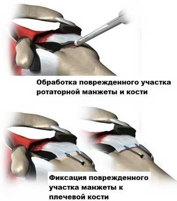 Обработка повреждённого участка ротаторной манжеты и кости