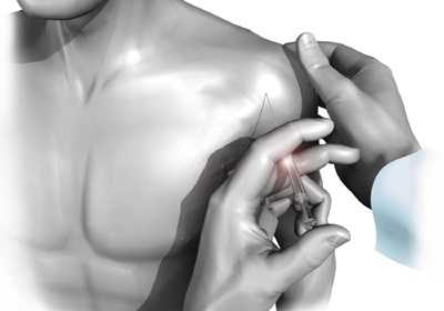 Консервативное лечение вращательной манжеты