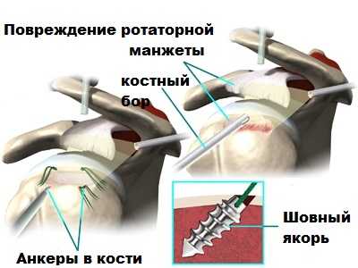 Повреждение ротаторной манжеты