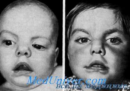 глухота с отсутствием большеберцовой кости