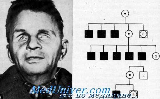 синдром норри