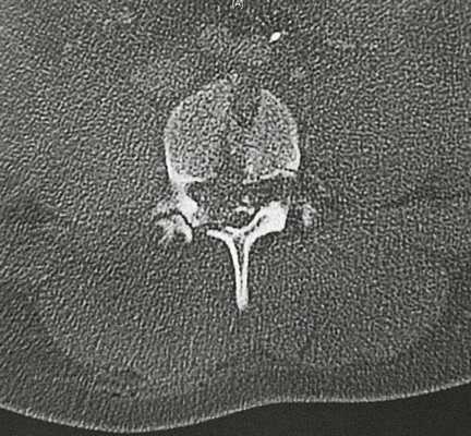 Раневой канал в теле поясничного позвонка.