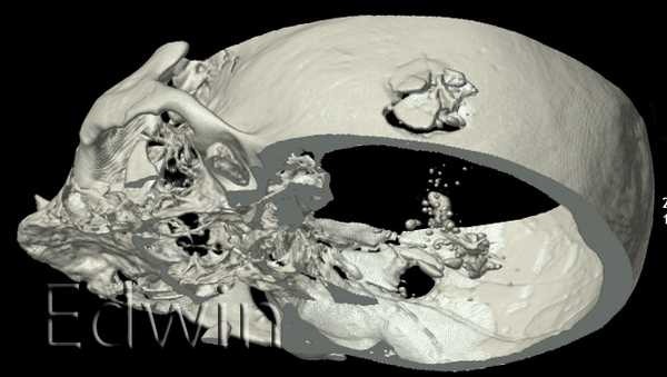 КТ сквозного огнестрельного повреждения головы оболочечной пулей.