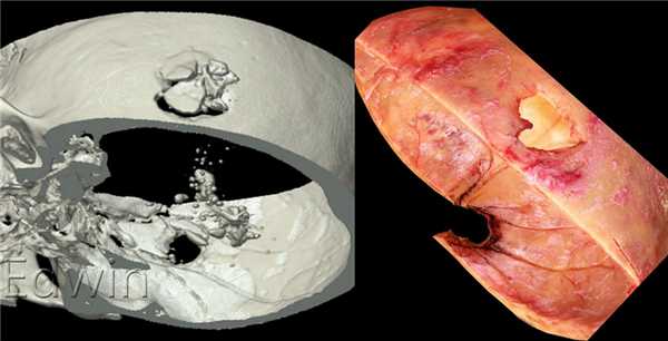 Огнестрельное повреждение головы оболочечной пулей.