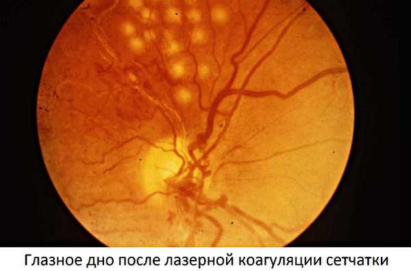 Лечение тромбоза ветви центральной вены сетчатки (ЦВС)