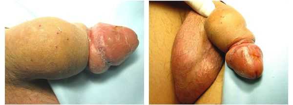 Признак олеогранулёмы