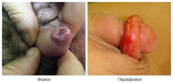 Фимоз и парафимоз