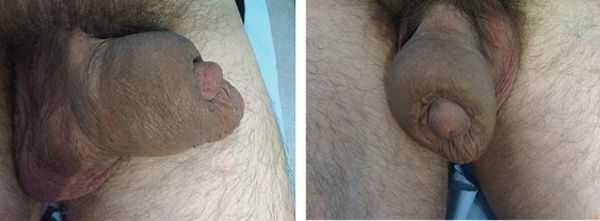 Гиперплазия оболочек полового члена