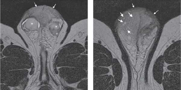 МРТ-картина олеогранулёмы