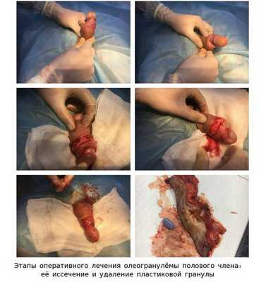 Этапы операции по устранению олеогранулёмы