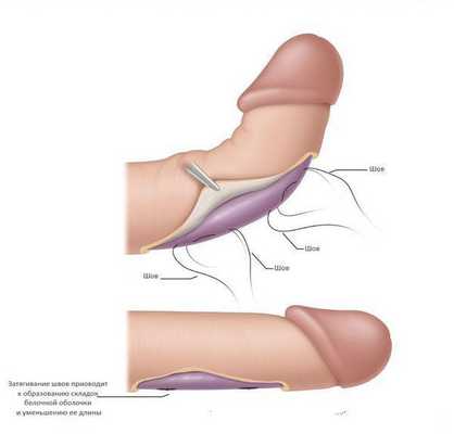 Гофрирующая методика