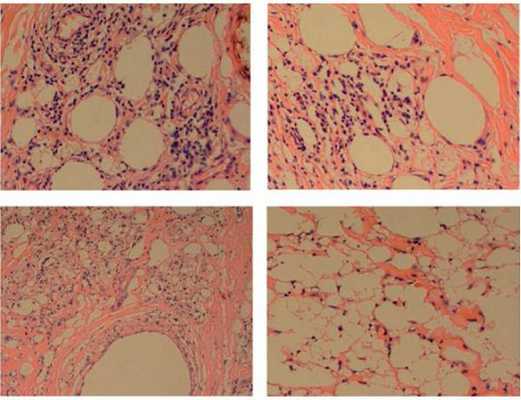 Гранулематозная реакция