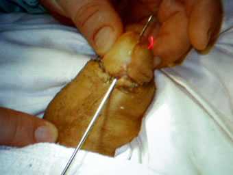 лечить олеогранулему полового члена