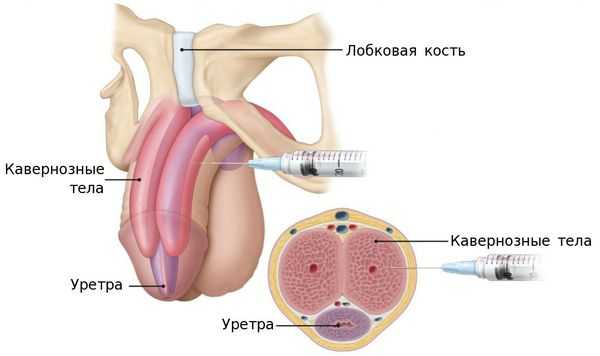 Введение масел в кавернозное тело