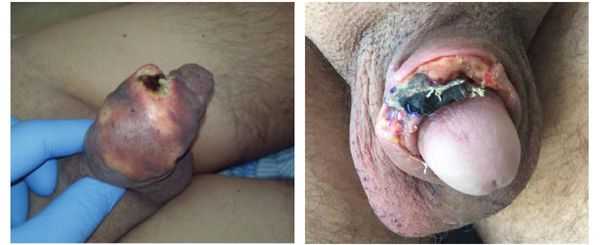 Некроз полового члена