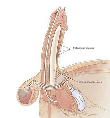 Фаллопротезирование
