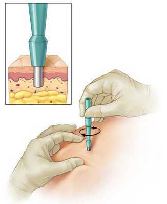 Выполнение биопсии
