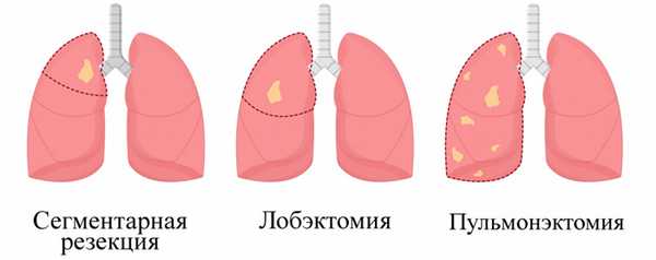 Операция по удалению легкого