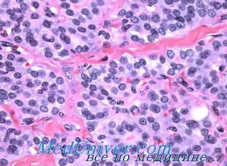 онкоцитарная аденома