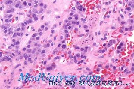 диагностика рака щитовидной железы