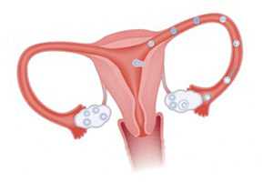 Оофорит. Воспаление яичников
