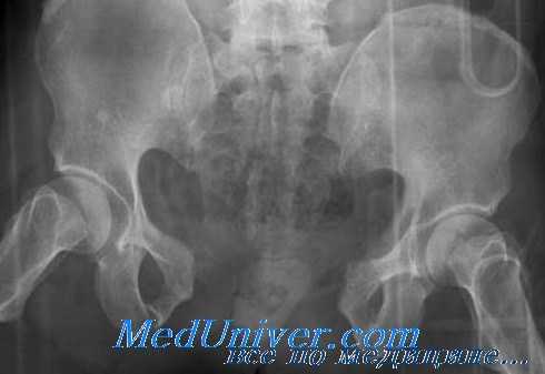 тазовое кровотечение