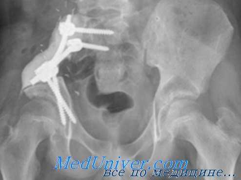 остановка тазового кровотечения