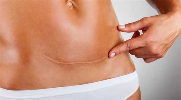 последствия после лапаратомической операции