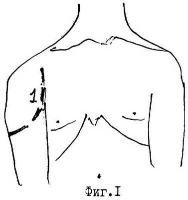 Способ оперативного доступа к плечевому суставу