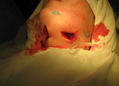 Диализ постоперационной раны через дренажную трубку