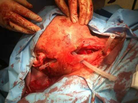 Хирургическая операция вскрытия поднижнечелюстного нагноения мягких тканей.