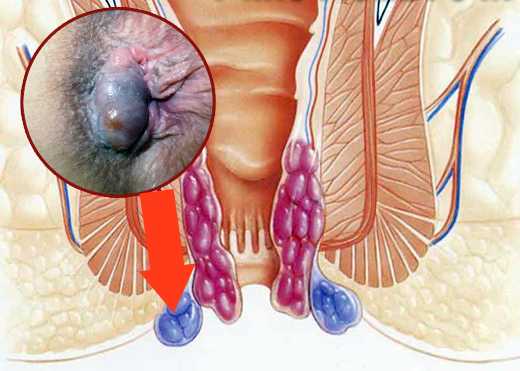 Геморроидальный узел