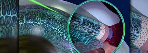 Лазерное лечение глаукомы - методы