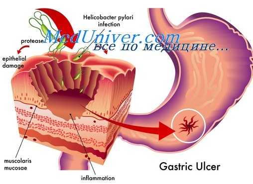 дуоденальные язвы