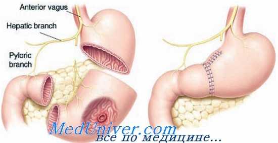 дистальная резекция желудка
