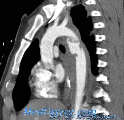 операции при травме аорты