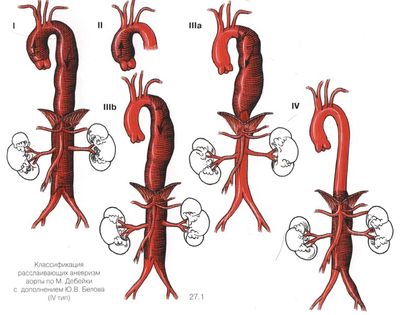Классификация аневризм аорты
