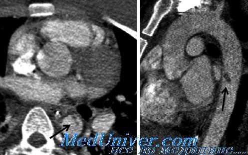 травма артерий